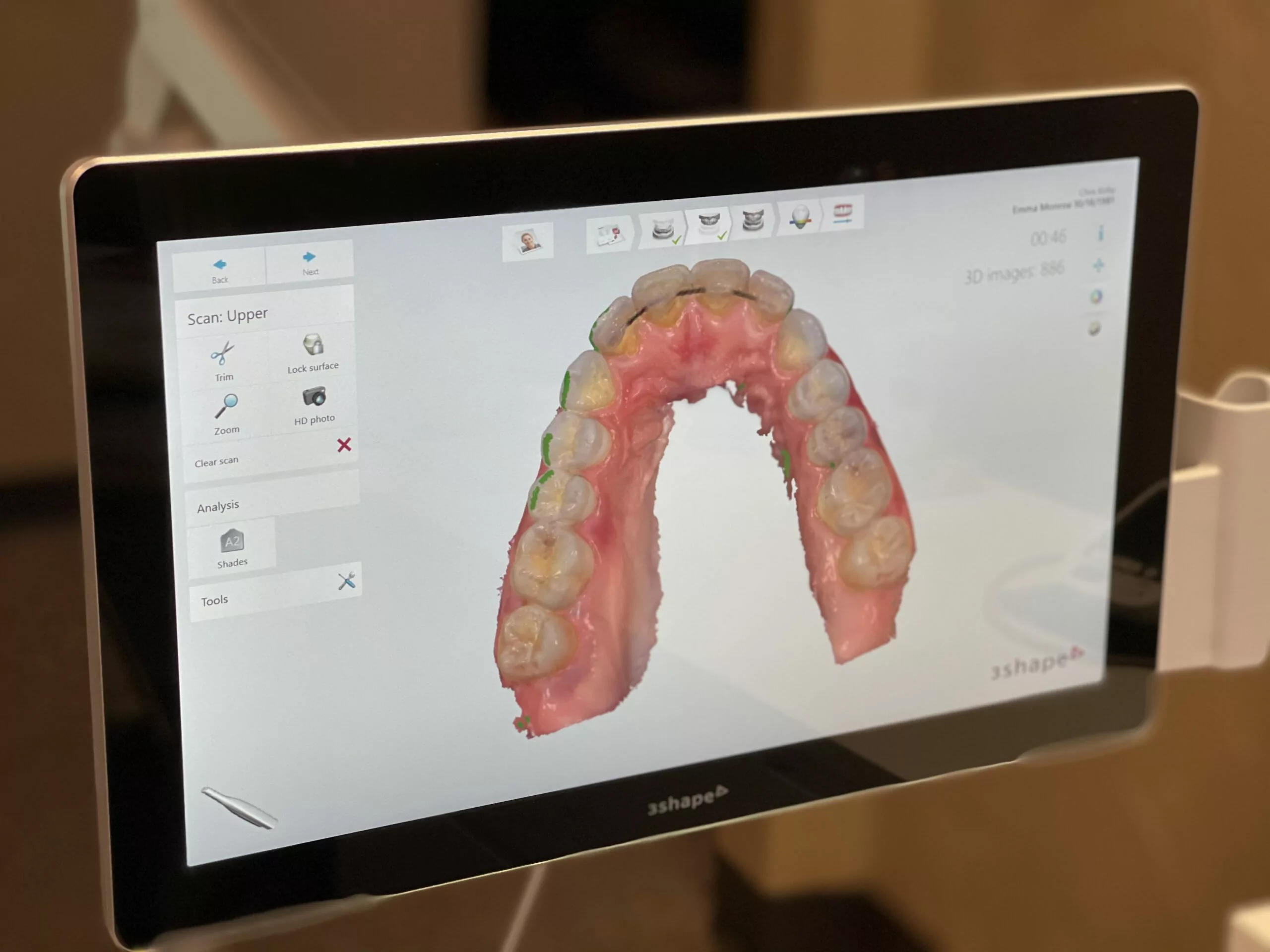 A 3D scan of teeth on a computer monitor at Vaca Dental in Longview, TX