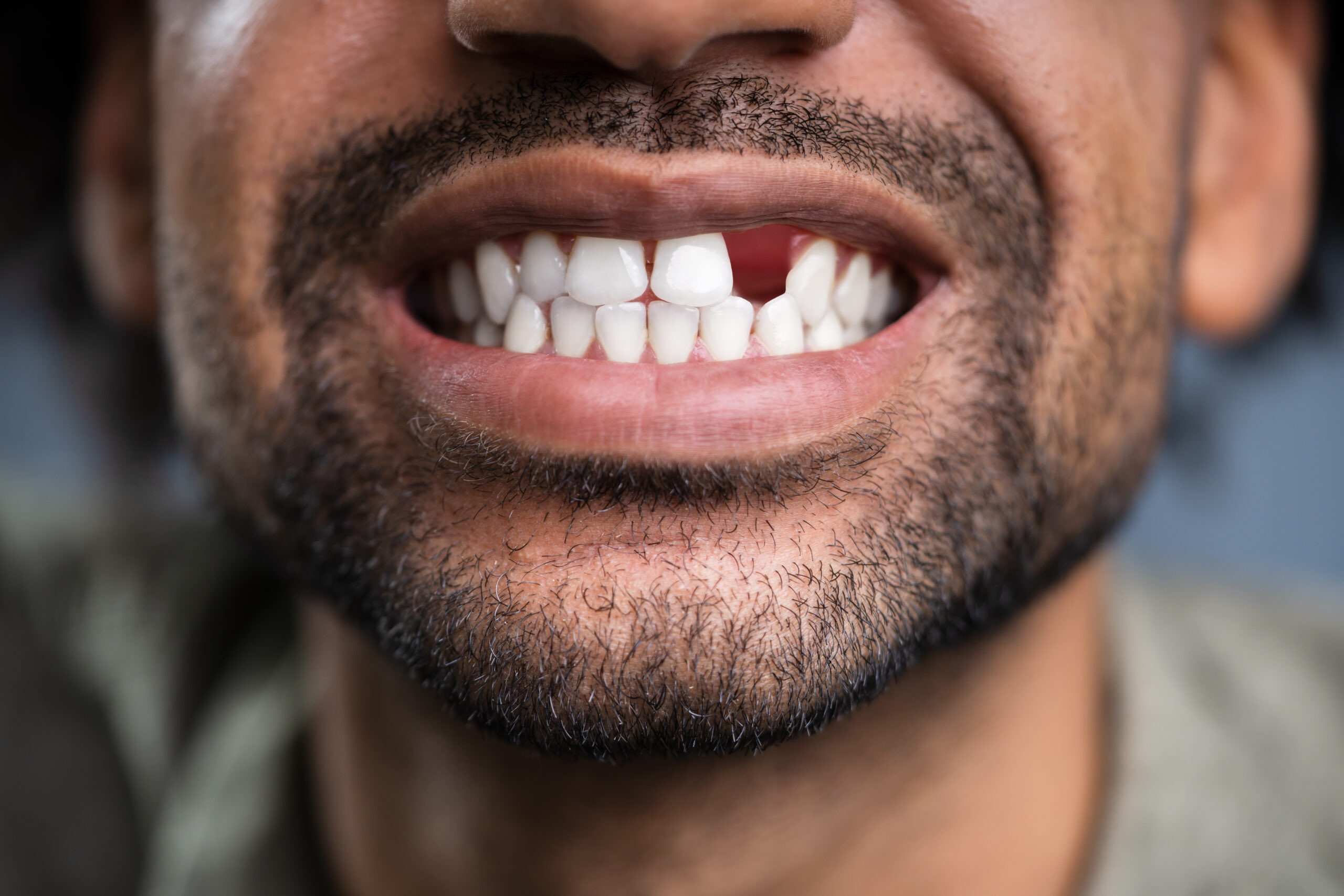 closeup of a man with a missing front tooth
