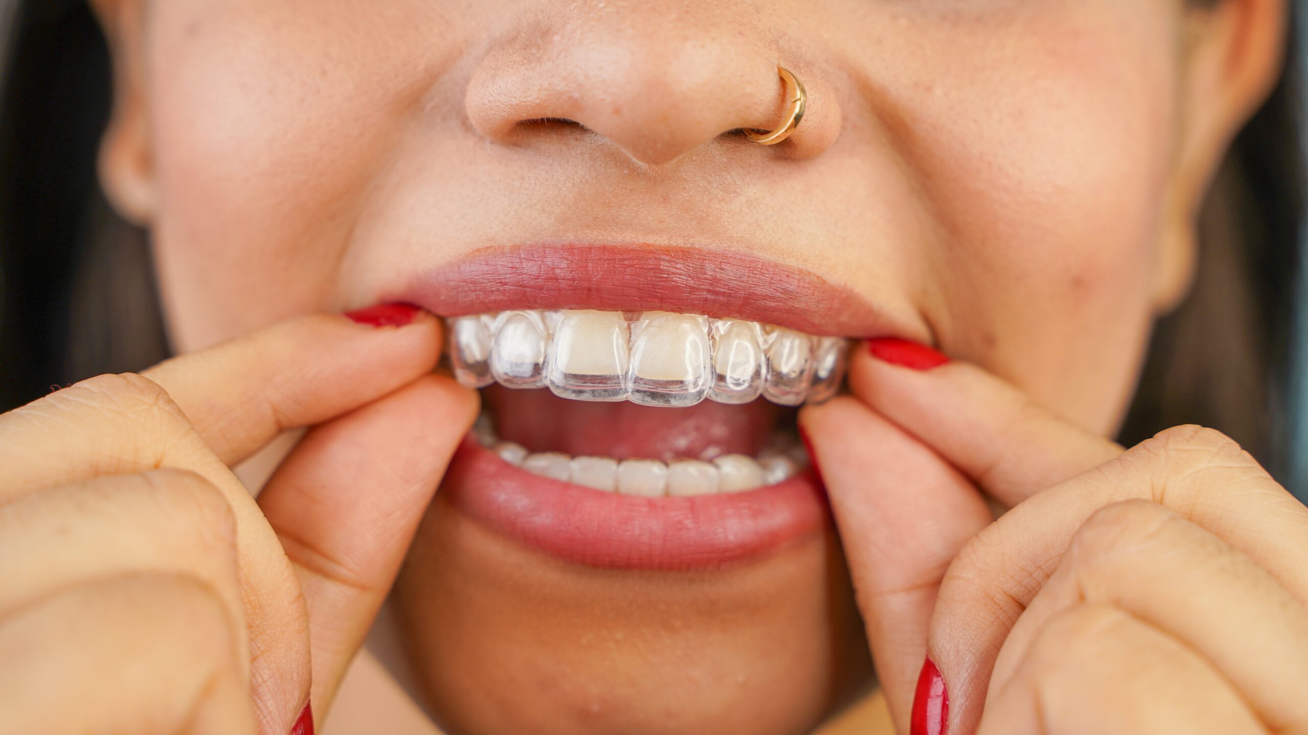 young woman putting in her clear aligners, improved oral health