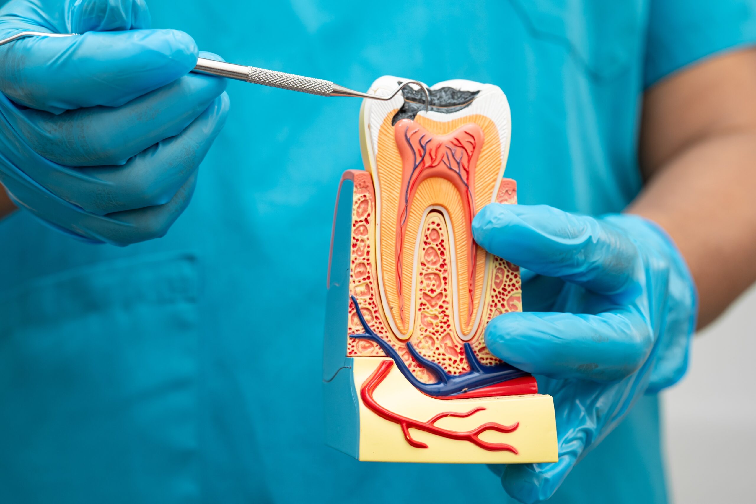 dentist showing model tooth with decay in pulp, need for root canal therapy