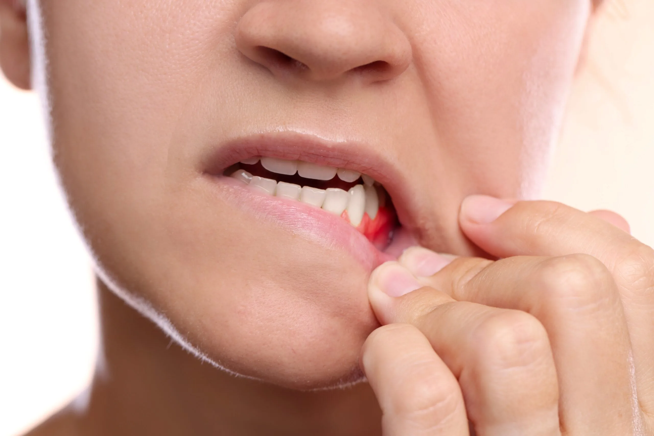 closeup of a woman pulling down her lip exposing inflamed gum