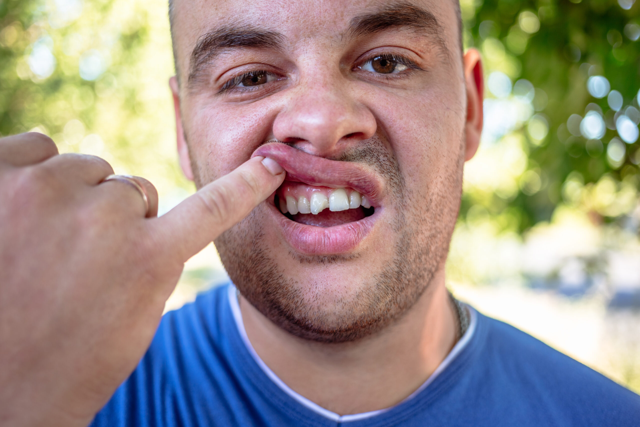 young man in a blue shirt exposing a chipped tooth