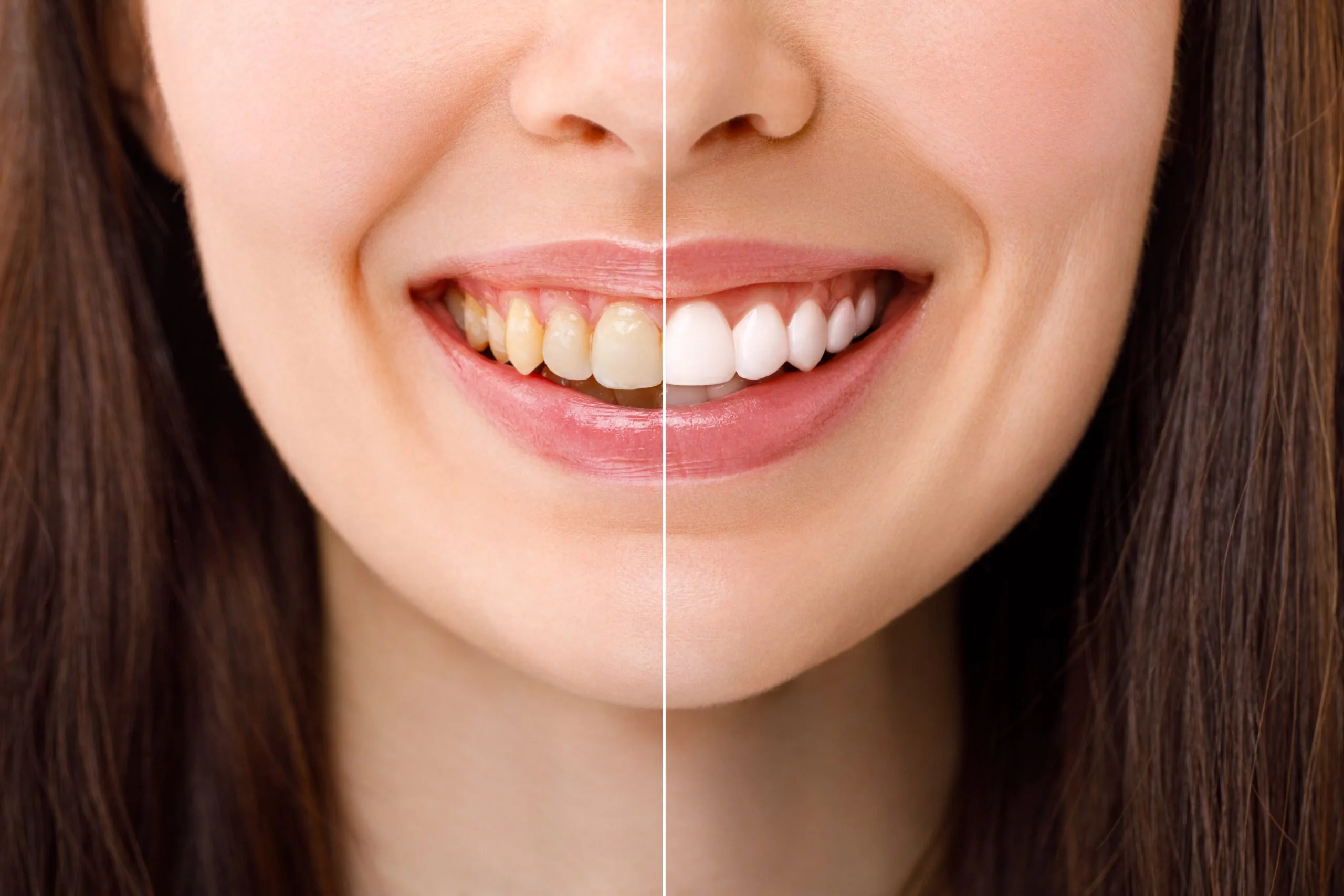 closeup of a before and after, professional teeth whitening