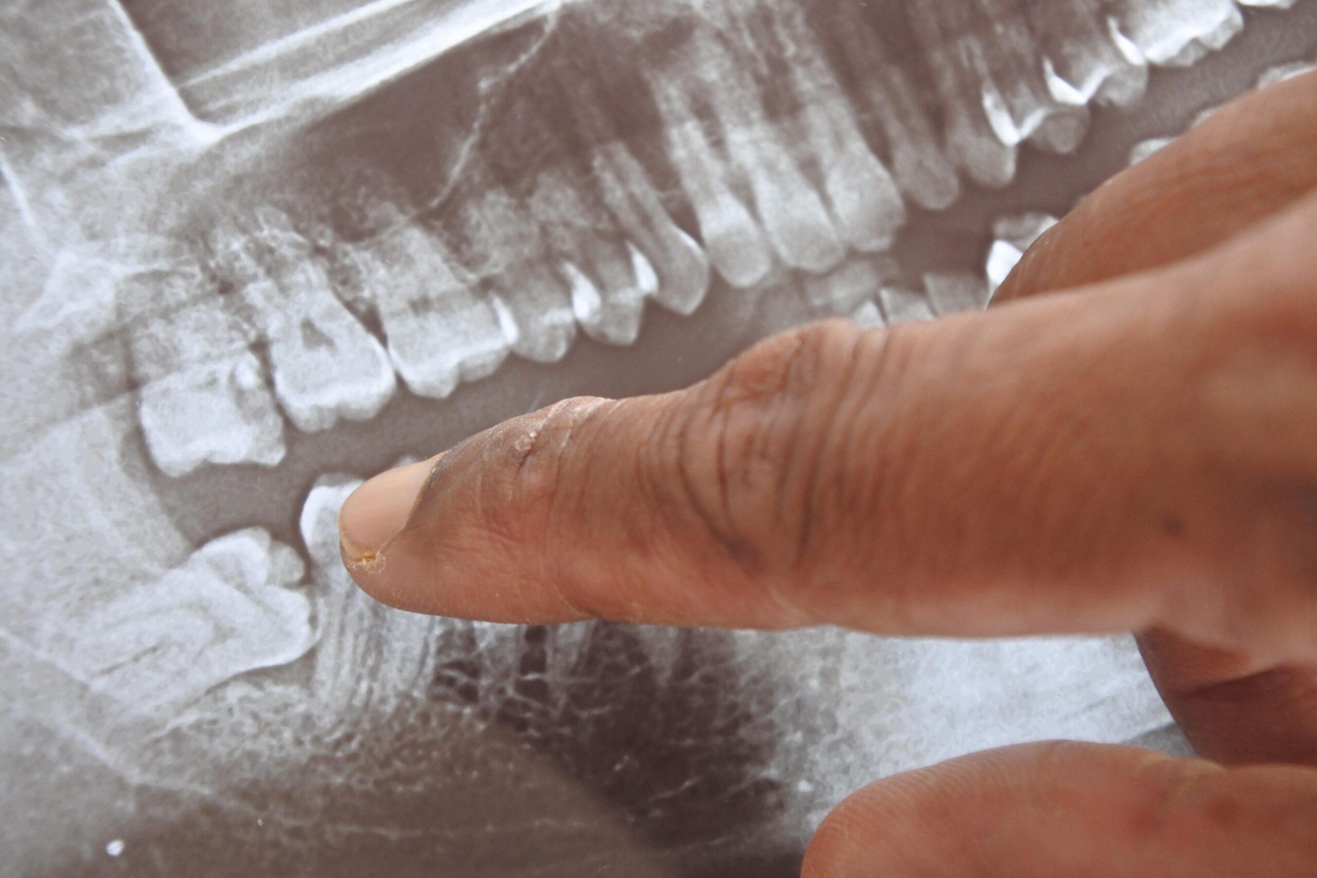 Panoramic x-ray image of teeth and mouth with wisdom teeth, impacted wisdom tooth. Dental care.